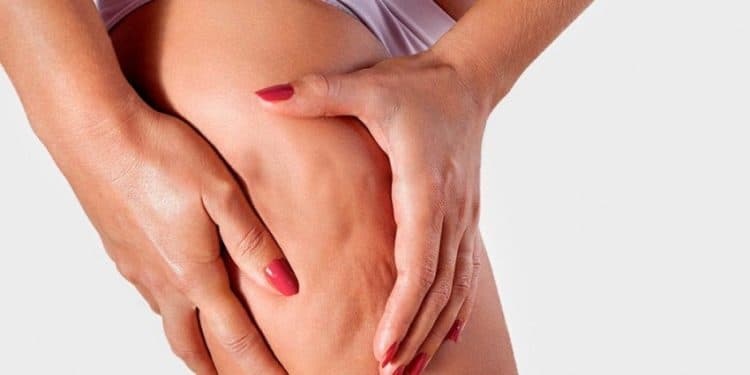 Si të shpëtoni nga celuliti? Dermatologët kanë disa sugjerime