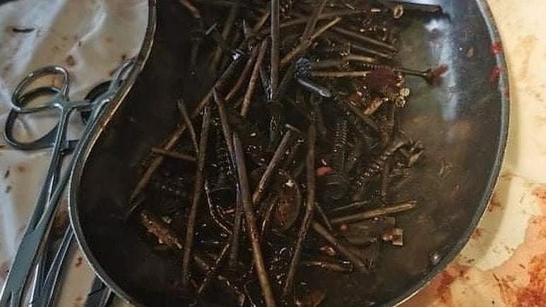 Mjekët gjejnë 1 kg bulona në stomakun e një burri