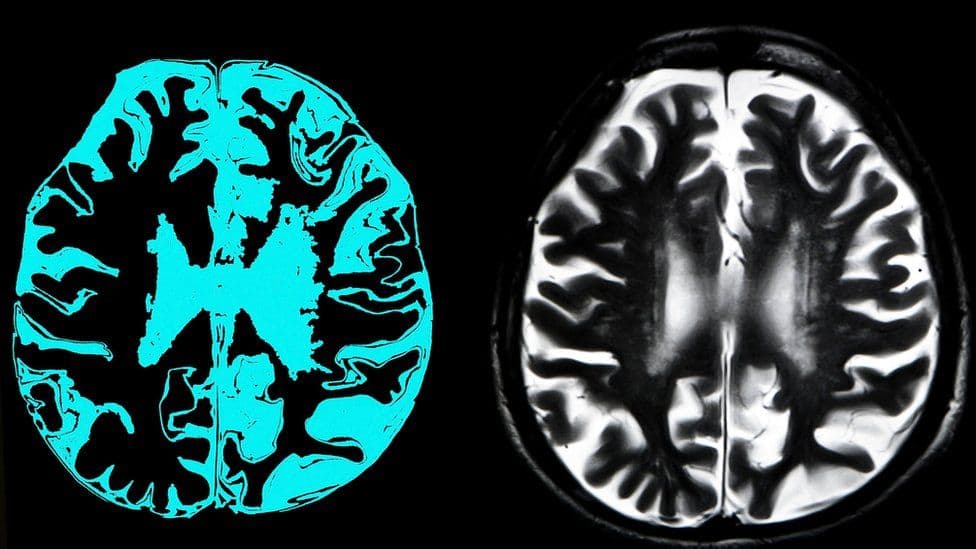 Ilaçi i Alzheimerit nuk miratohet nga BE për përdorim