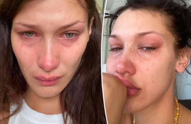 Bella Hadid flet për betejat e saj “torturuese” me shëndetin mendor
