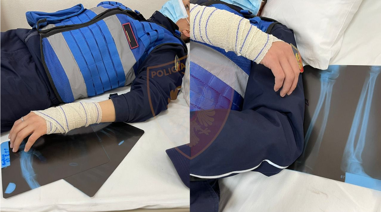 Përplasjet te “5 Maji”/ Policia: 5 efektivë dhe 3 policë bashkiak në Spitalin e Traumës