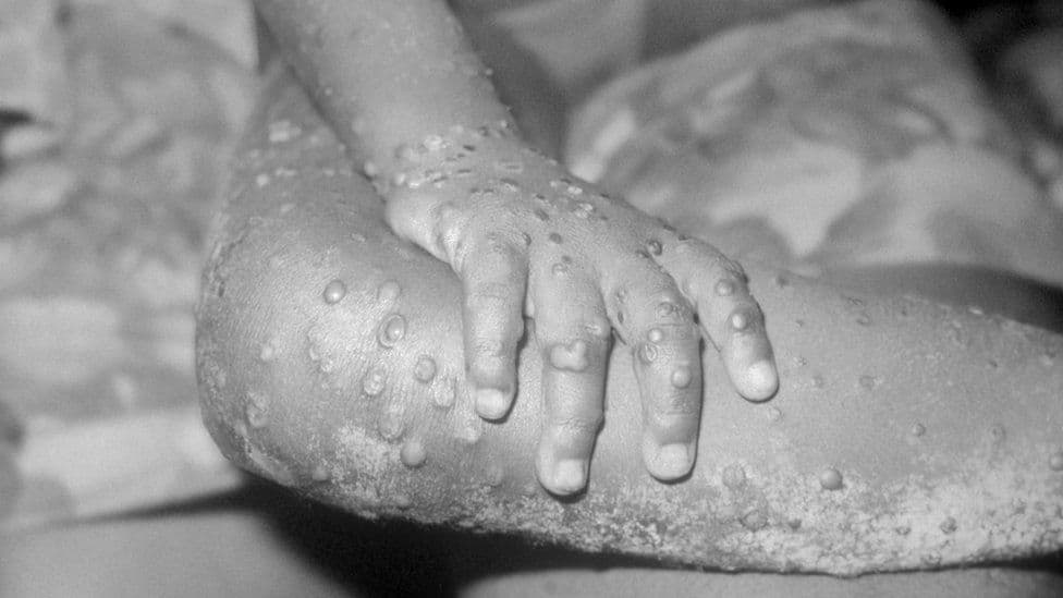 Lija e majmunëve, konfirmohen raste në Belgjikë, Francë, Australi dhe Gjermani