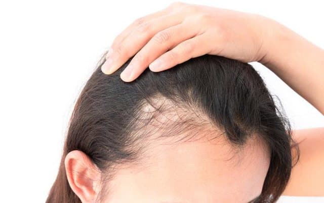 Alopecia Areata, EMA jep dritën jeshile për ilaçin e parë për trajtimin e rënies së flokëve