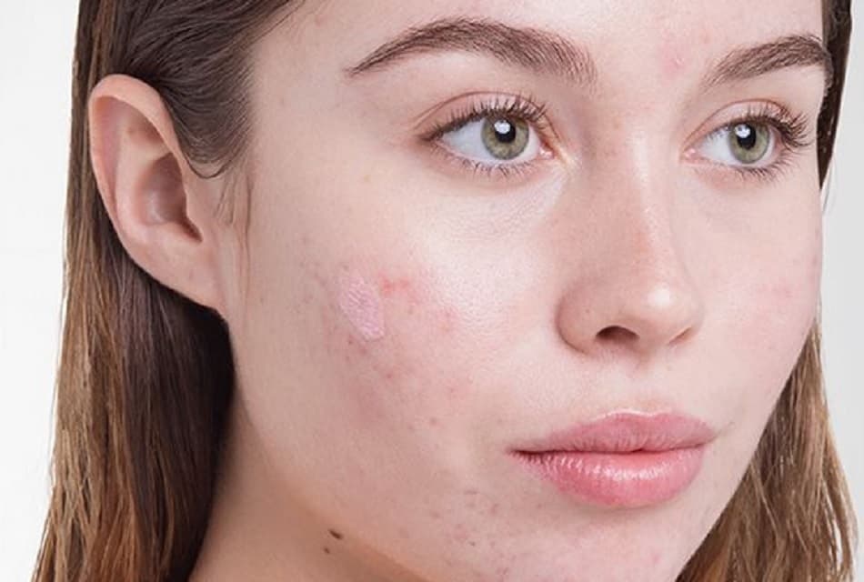 Aknet në fytyrë, dermatologu zbulon 5 gabimet që bëjmë të gjithë