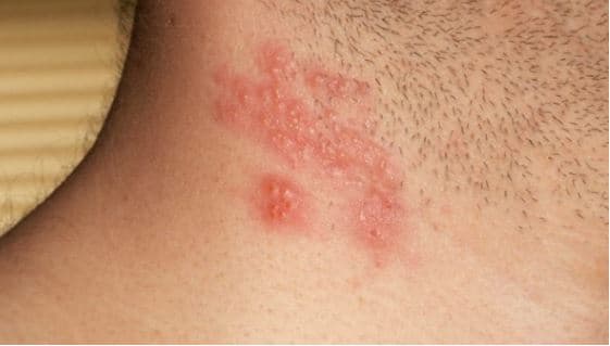 Herpes, rrit rrezikun e goditjes dhe sulmit në zemër me 30%