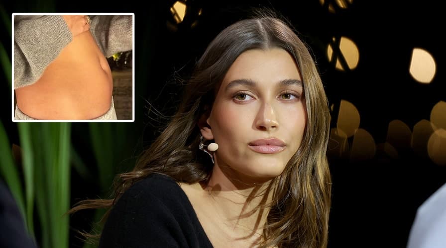 "Nuk jam shtatzënë", Hailey Bieber tregon se ka një kist në madhësinë e një molle (FOTO)