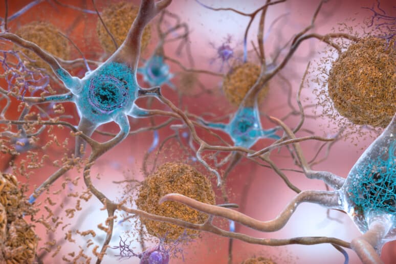 Një ilaç i ri ngadalëson progresin e Alzheimerit
