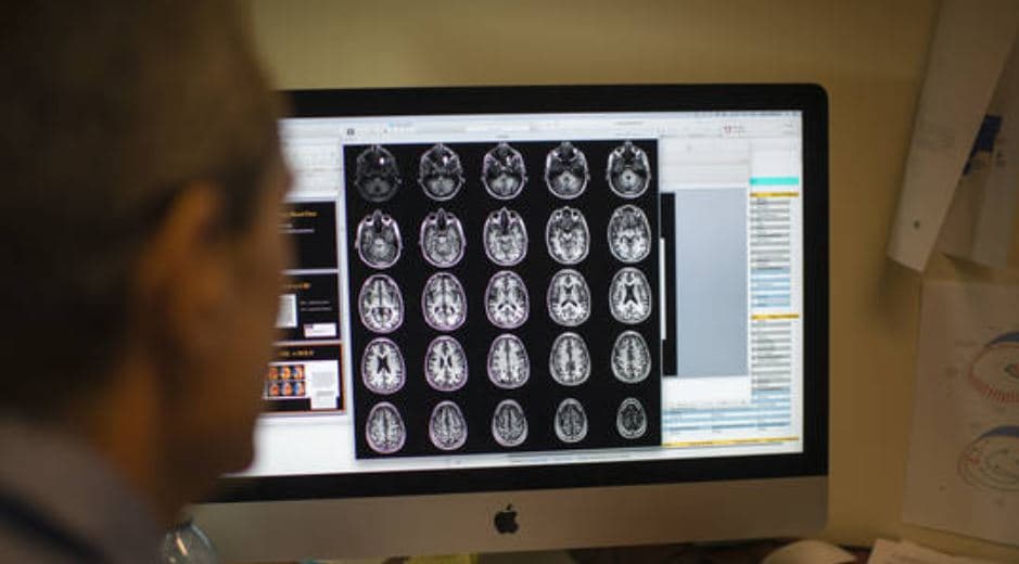 Shkencëtarët bëjnë një zbulim revolucionar mbi Alzheimerin 