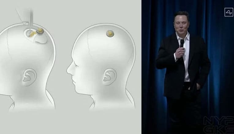 Rezulton i suksesshëm instalimi i çipit në tru/ Musk: Pacienti mund të lëvizë mous-in përmes mendimit