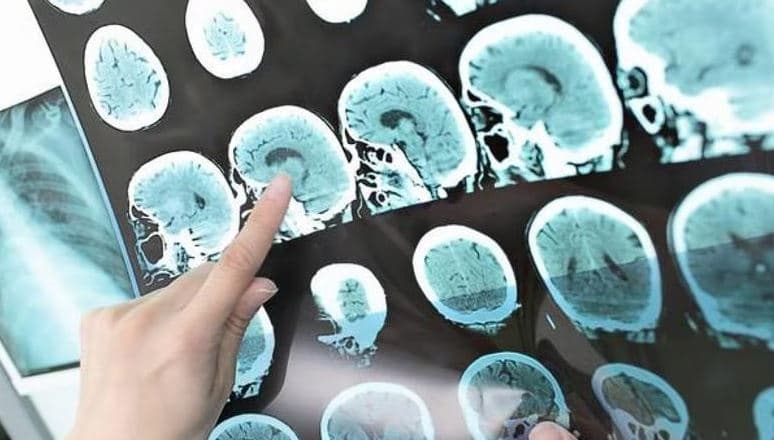 Shenjat e para të alzheimerit mund të shfaqen deri në 18 vjet përpara diagnozës