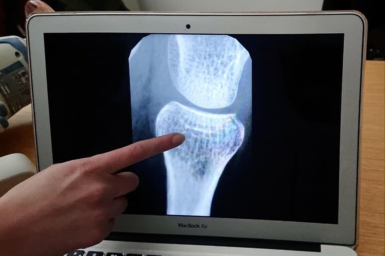 Zbulohet një proteinë që mund të shërojë osteoporozën