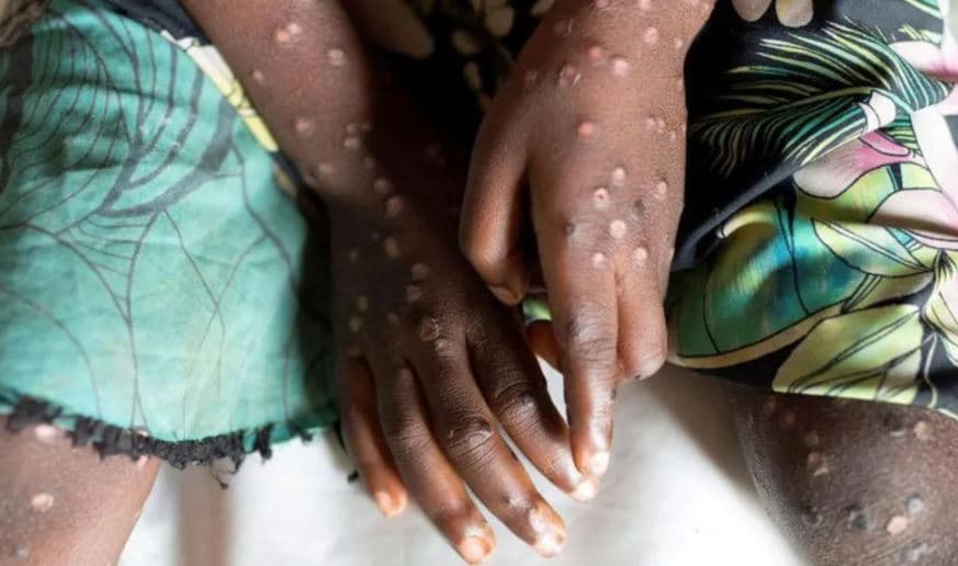 Qytetarët që do të udhëtojnë drejt Afrikës këshillohen të vaksinohen kundër lisë së majmunëve