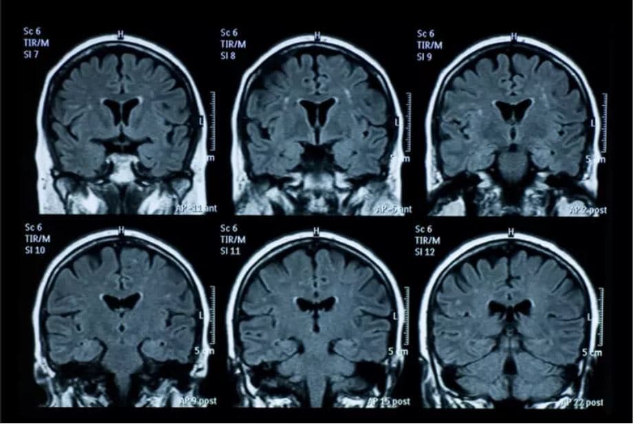 Një virus që e kalojmë në fëmijëri mund të shkaktojë Alzajmer