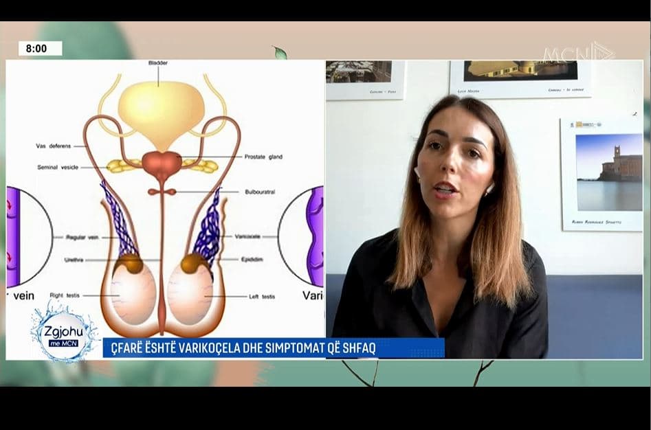 Varikoçela në testikuj/ Urologia Ndervataj: Një nga shkaqet më të shpeshta të infertilitetit mashkullor 