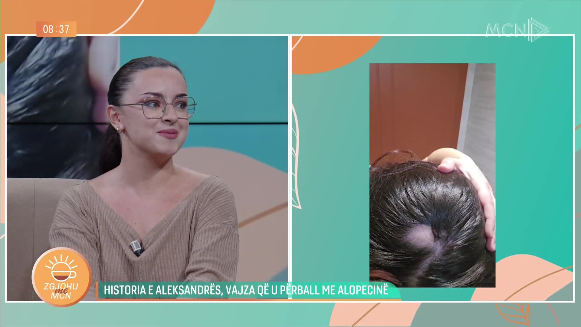Historia e Aleksandrës, vajza që u përball me alopecinë si pasojë e stresit