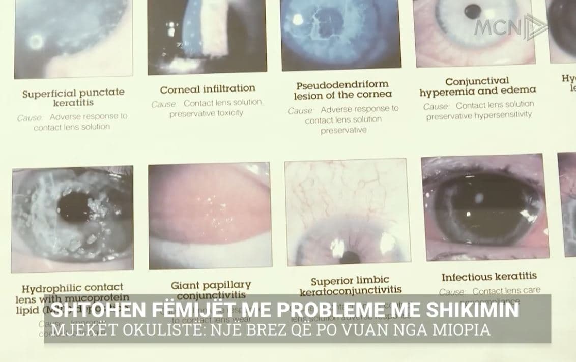 Shtohen fëmijët me probleme me shikimin/ Mjekët okulistë: Një brez që po vuan nga miopia (VIDEO)