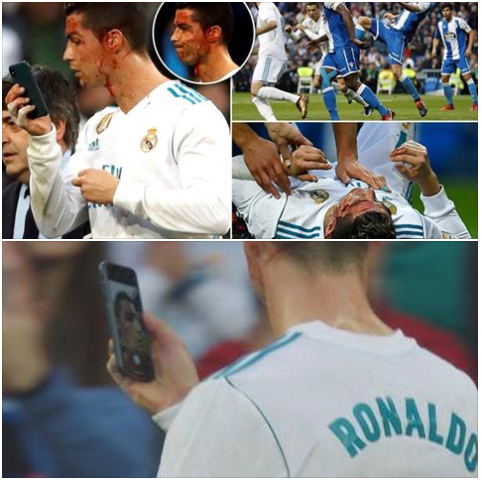 Nuk është selfie, por shikimi i plagës që CR7 mori në ndeshjen me La Corunan (VIDEO)