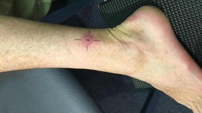 Australia në alarm, epidemija e ulçerës së mishit po përhapet me shpejtësi