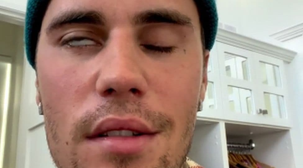 Justin Bieber anulon koncertet, zbulon paralizën e fytyrës
