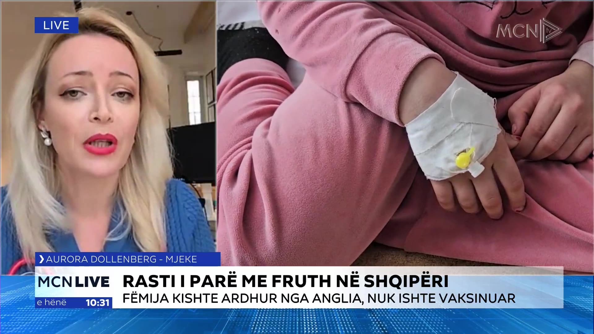Rasti i parë me fruth në Shqipëri/ Dollenberg: Vaksina nuk përbën rrezik, jetëshpëtuese për fëmijët (VIDEO)