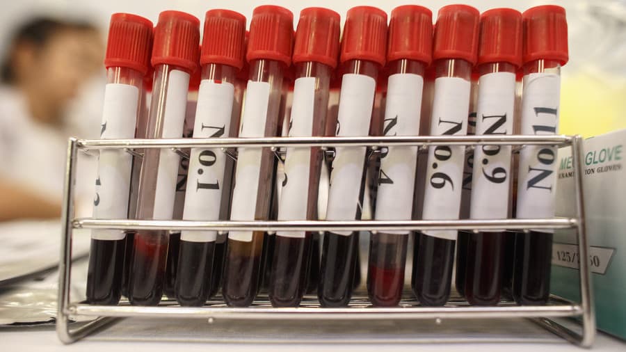 Një metodë e re studimi mund të çojë drejt vaksinës kundër AIDS-it